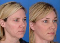 45-54 year old woman treated with Facelift and Endoscopic Browlift