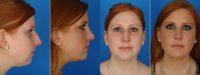 Nose Surgery (Rhinoplasty), Chin Augmentation