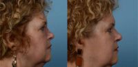 65-74 year old woman treated with reconstructive rhinoplasty