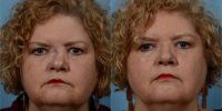 65-74 year old woman treated with reconstructive Rhinoplasty