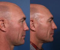 35-44 year old man treated with Revision Rhinoplasty