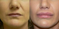 35-44 year old woman treated with Lip Augmentation using Alloderm