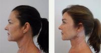 Doctor Shim Ching, MD, Honolulu Plastic Surgeon - 45 Year Old Woman Treated With Facelift