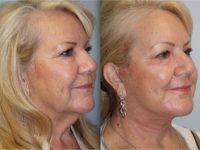 66 year old woman treated with Neck Lift