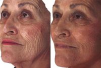 Female Facelift and Laser Resurfacing