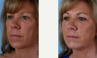 Doctor Theda C. Kontis, MD, Baltimore Facial Plastic Surgeon - 63 Year Old Woman Treated With Facelift