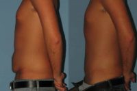 18-24 year old man treated with Male Tummy Tuck