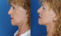 65-74 year old woman treated with a deep plane Facelift