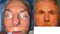 45-54 year old man treated with Facial Reconstructive Surgery