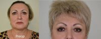 55-64 year old woman treated with Facelift