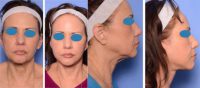 55-64 year old woman treated with Deep plane (HGH SMAS) Facelift