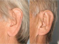 67 year old man treated with Ear Lobe Surgery