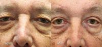 55-64 year old man treated with Browlift