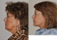65-74 year old woman treated with facelift & neck