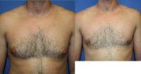 25-34 year old woman treated with Male Breast Reduction