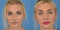 18-24 year old woman treated with Lip Filler