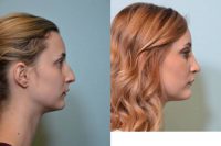 26 year old woman treated with Rhinoplasty with Chin Implant