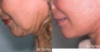 Facelift in 56 Year Old Female