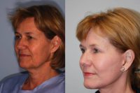 59 year old female desires facial rejuvenation