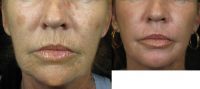 Woman in her 50s treated with C02 laser