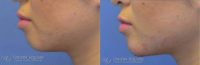 Chin enhancement using Restylane filler