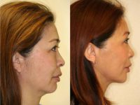 55-64 year old woman treated with Facelift, Brow Lift, Midface Lift, Eyelid Lift, and Chin Implant