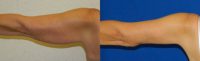 45-54 year old woman treated with Arm Lift