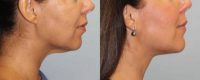 46 year old woman treated with Neck Lift