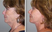 Lower face and neck lift, fat transfer, fractional laser skin resurfacing