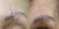72 year old woman treated with Scars Treatment