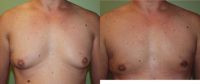 35-44 year old man treated with Male Breast Reduction