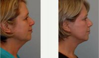 Dr Elisa A. Burgess, MD, Portland Plastic Surgeon - 57 Year Old Woman Treated With Face And Neck Lift
