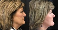 55-64 year old woman treated with FaceTite