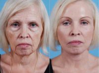 55-64 year old woman treated with a Facelift