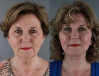 66 year old woman treated with Facelift