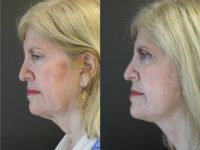 55-64 year old woman treated with Mini Lift
