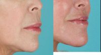 55-64 year old woman treated with Lip Lift