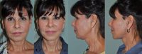 Face and Neck Lift & Rhinoplasty