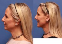 Woman in her 40s requested neck "tightening".