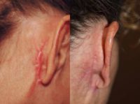 Facelift Scar treatment with Steroid Injections