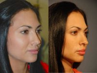 25-34 year old woman treated with Juvederm for Lip Augmentation