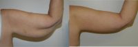 65-74 year old woman treated with Arm Lift