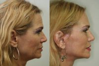 55-64 year old woman treated with Facelift, Endoscopic Forehead Lift