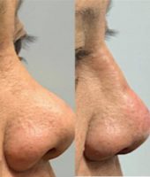 45-54 year old woman treated with Nonsurgical Nose Job