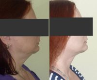 Woman treated with Facelift