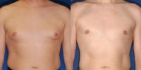 Gynecomastia - Donut Lift on a 40 year old male