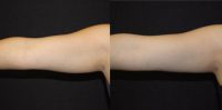 25-34 year old woman treated with CoolSculpting to arms
