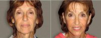 Dr Kevin F. Ciresi, MD, FACS, Fresno Plastic Surgeon - 68 Year Old Woman Treated With Facelift