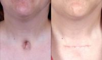 Woman in her 30's treated for a depressed, unsightly scar related to previous tracheotomy