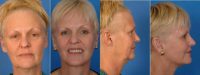 Facelift/neck lift with upper and lower eyelid lift